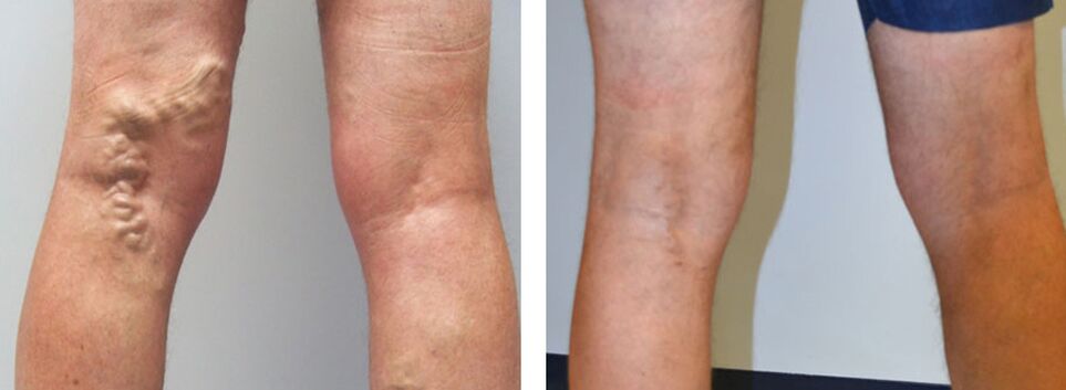 Foto antes e depois de usar Veniselle, a experiência de usar creme