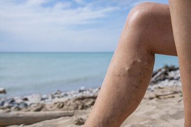 Varizes veias nas pernas