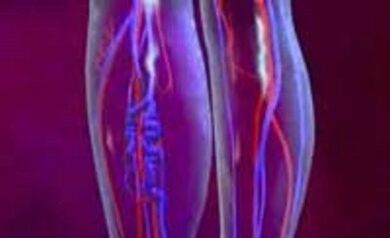 Causas e tratamento de varizes