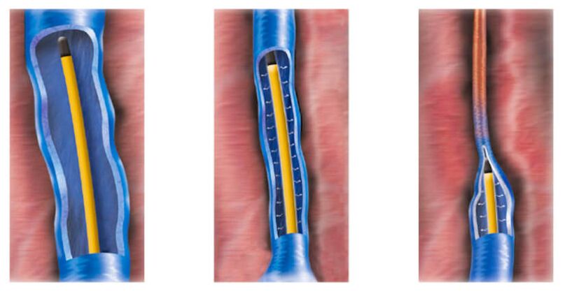 ablação por radiofrequência como método de tratamento de varizes