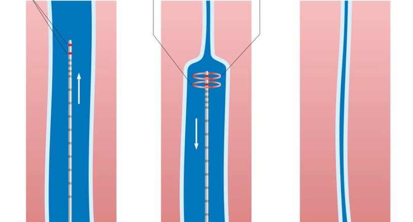 tratamento a laser para varizes nas pernas