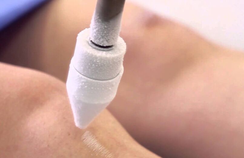 tratamento de varizes nas pernas com crioterapia